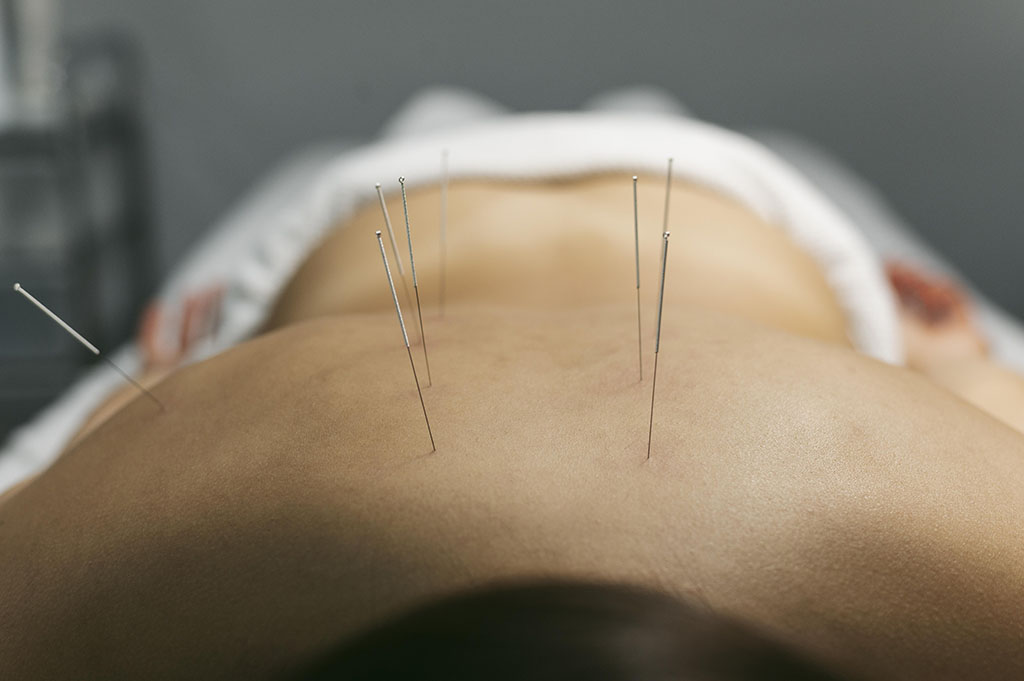 acupuncture-process-for-client