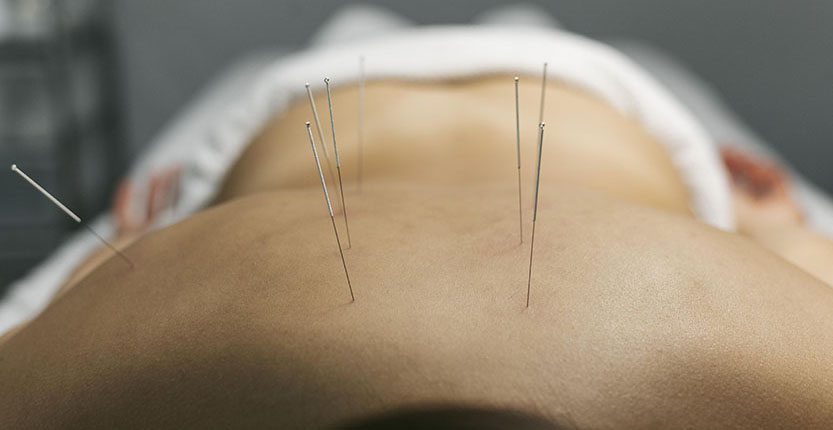 acupuncture-process-for-client1 (1)